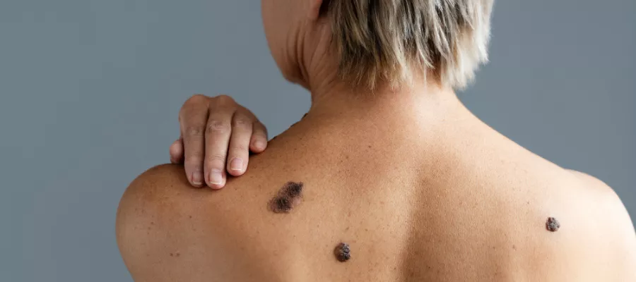 What are Nevus of Ota and Nevus of Ito and How Are They Treated?