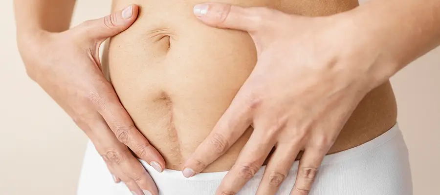 Doğum Sonrası Sarkma