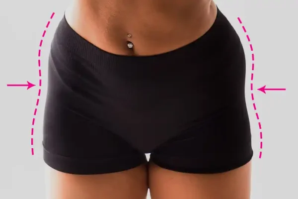 Sculptura Hip Dips Tedavisi